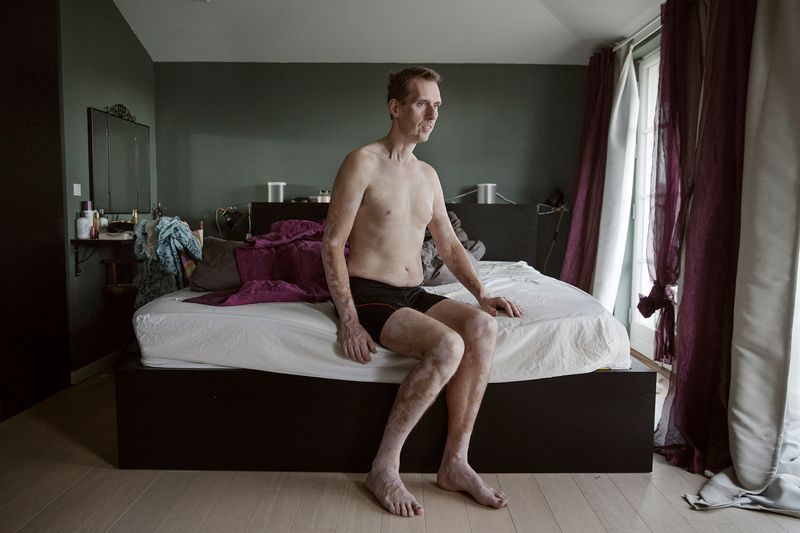 © Rosa Mariniello - Image from the VITILIGO photography project