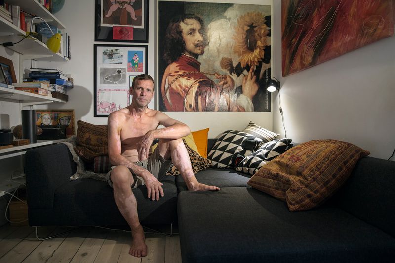 © Rosa Mariniello - Image from the VITILIGO photography project