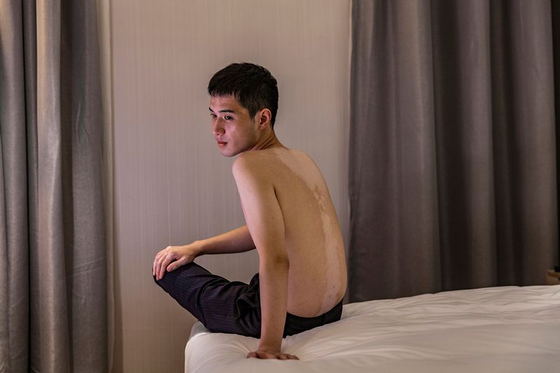 © Rosa Mariniello - Image from the VITILIGO photography project