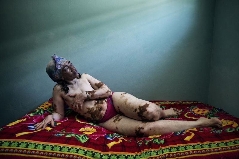 © Rosa Mariniello - Image from the VITILIGO photography project