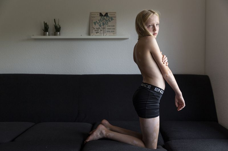 © Rosa Mariniello - Image from the VITILIGO photography project