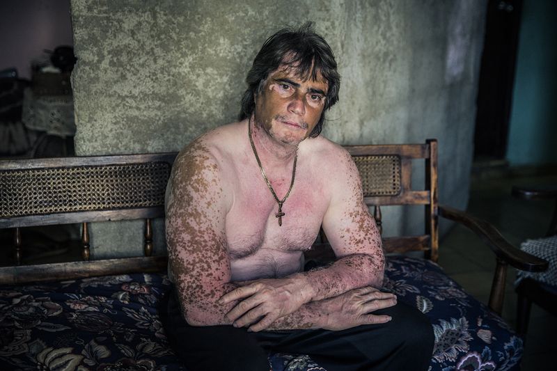 © Rosa Mariniello - Image from the VITILIGO photography project