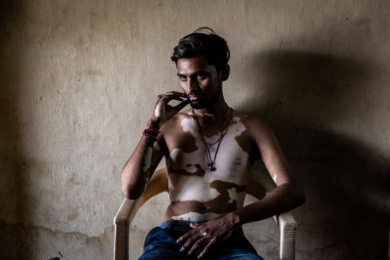 © Rosa Mariniello - Image from the VITILIGO photography project