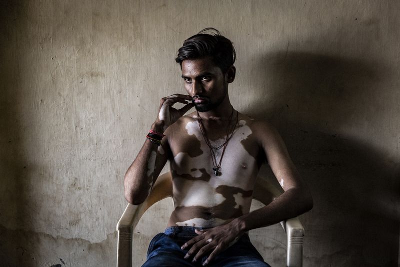 © Rosa Mariniello - Image from the VITILIGO photography project