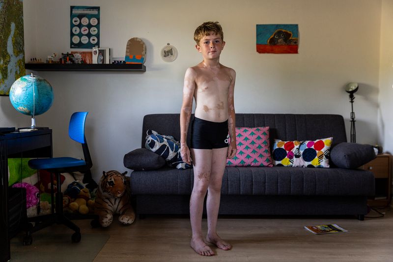 © Rosa Mariniello - Image from the VITILIGO photography project