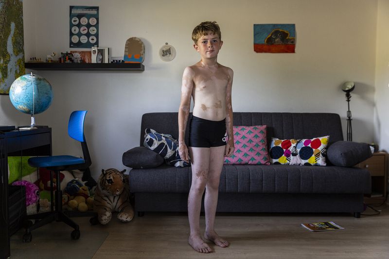 © Rosa Mariniello - Image from the VITILIGO photography project