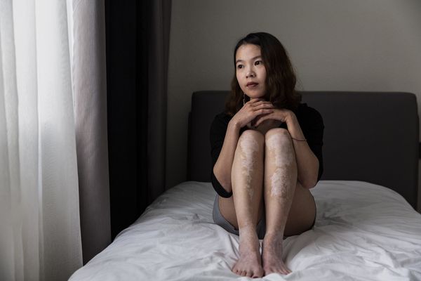 © Rosa Mariniello - Image from the VITILIGO photography project