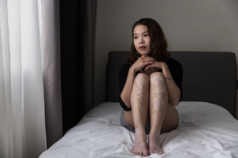 © Rosa Mariniello - Image from the VITILIGO photography project