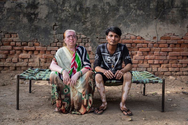 © Rosa Mariniello - Image from the VITILIGO photography project