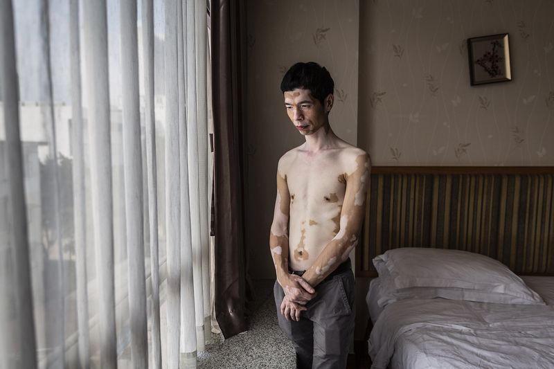 © Rosa Mariniello - Image from the VITILIGO photography project