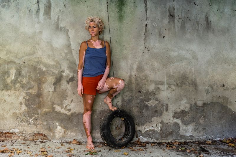 © Rosa Mariniello - Image from the VITILIGO photography project