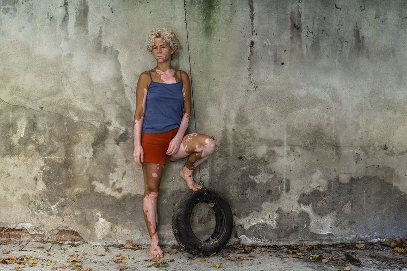 © Rosa Mariniello - Image from the VITILIGO photography project