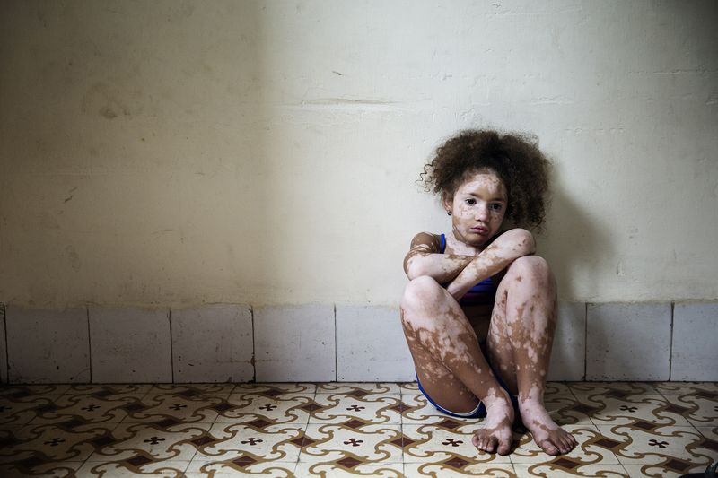 © Rosa Mariniello - Image from the VITILIGO photography project