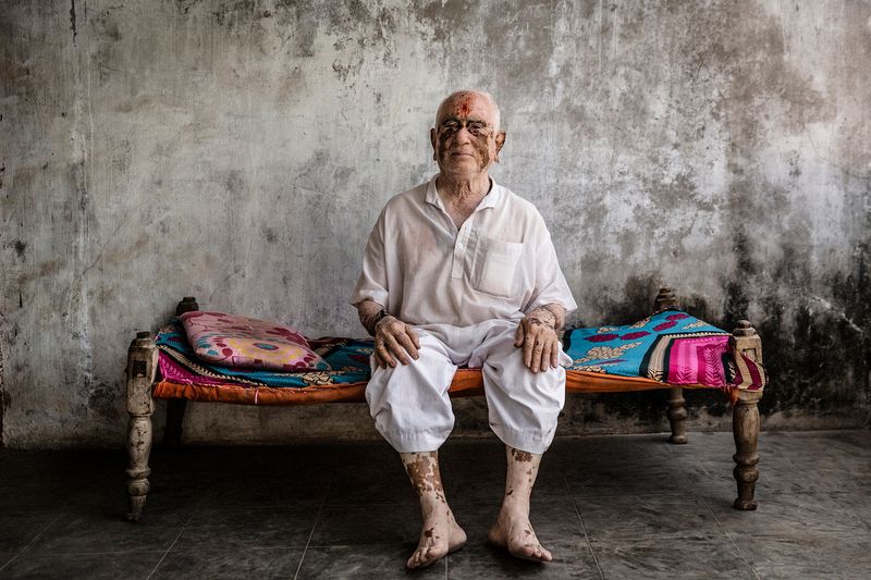 © Rosa Mariniello - Image from the VITILIGO photography project