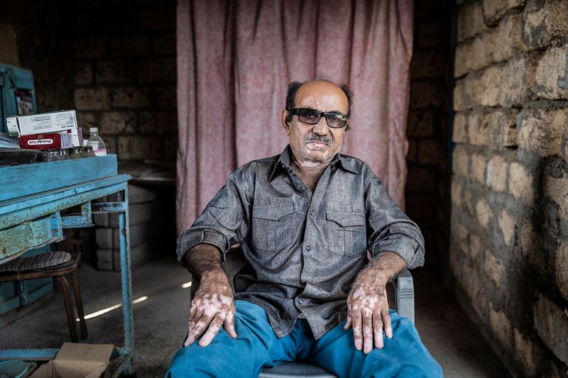 © Rosa Mariniello - Image from the VITILIGO photography project