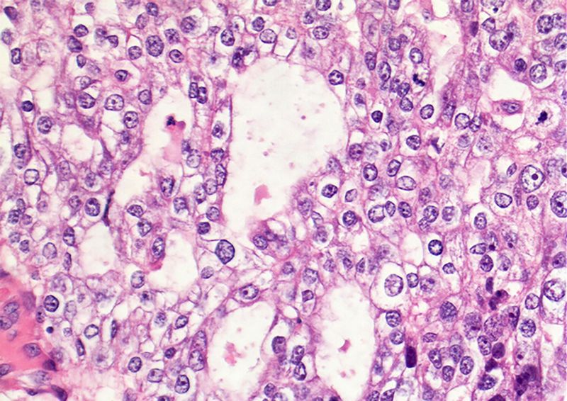 © Petra Kroon - Tissue of vaginal cancer, slide from Dutch Cancer Institute