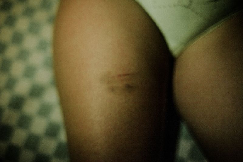 © Celine Croze - Thighs of Pretty eyes (prostitute and crystal meth addict) after being hit by his client. Tijuana, Mexico, 2018