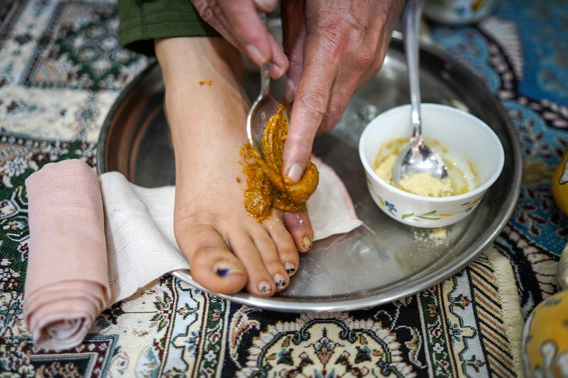 © Ali Rad - Hanieh is receiving traditional treatment for her broken toe.