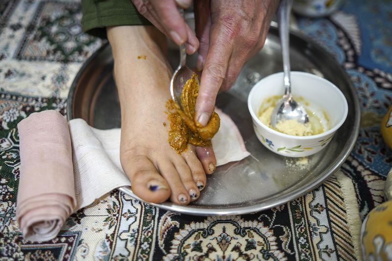 © Ali Rad - Hanieh is receiving traditional treatment for her broken toe.