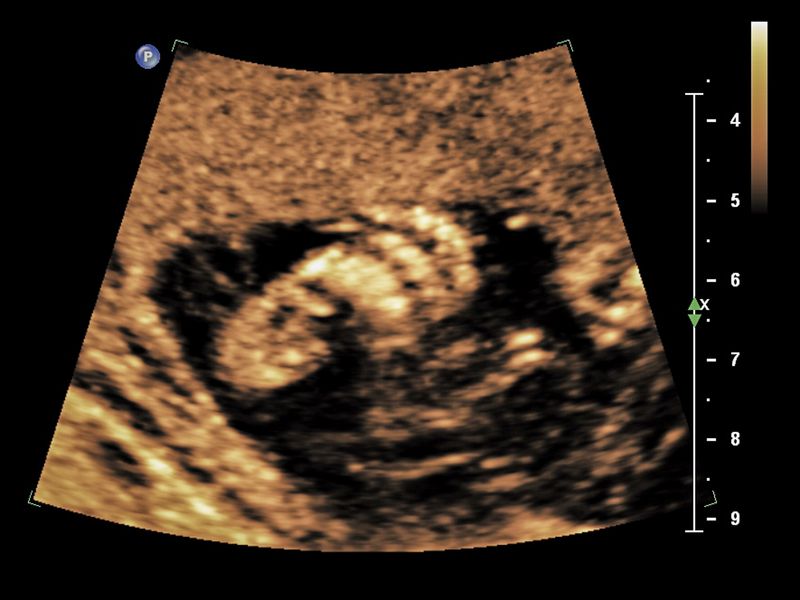 © Daniel Seiffert - Ultraschallbild Ella, Berlin 27. September 2011