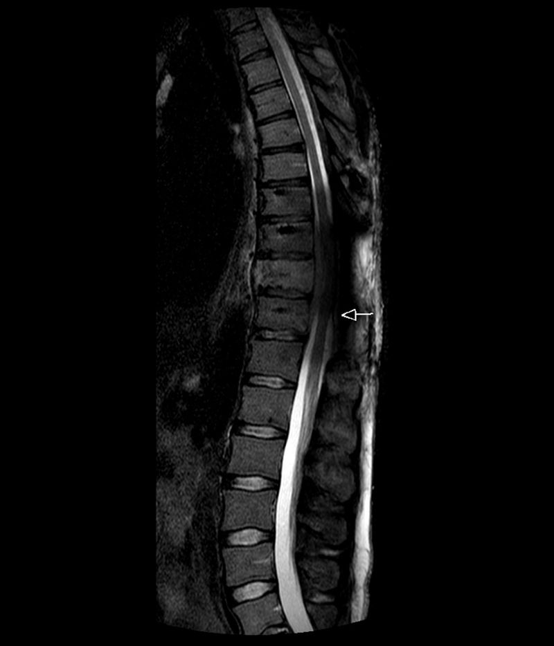 © Berber Theunissen - Beginning Paraplegia