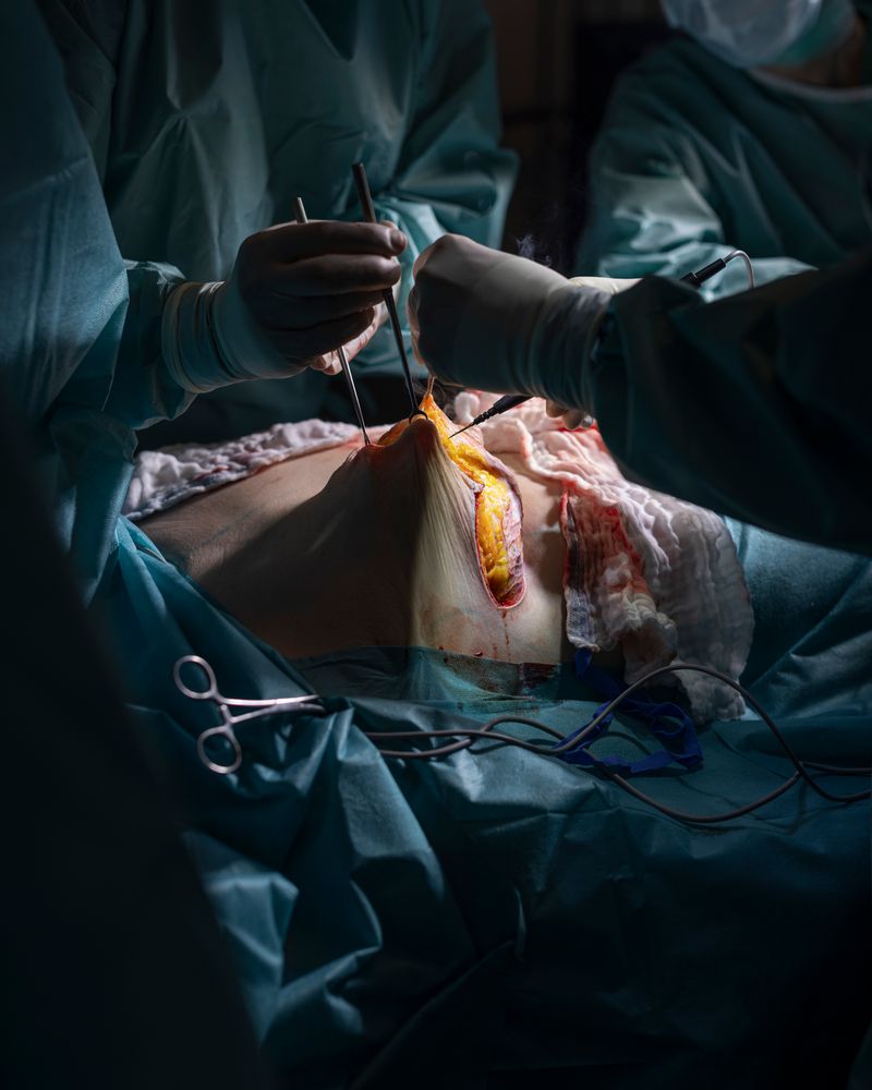 © Lina Czerny - The first documented breast augmentation was performed in 1895, using tissue from the patient’s back.