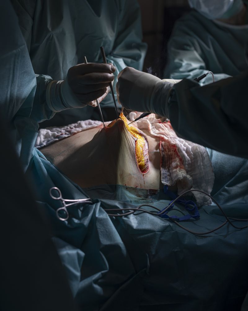 © Lina Czerny - The first documented breast augmentation was performed in 1895, using tissue from the patient’s back.