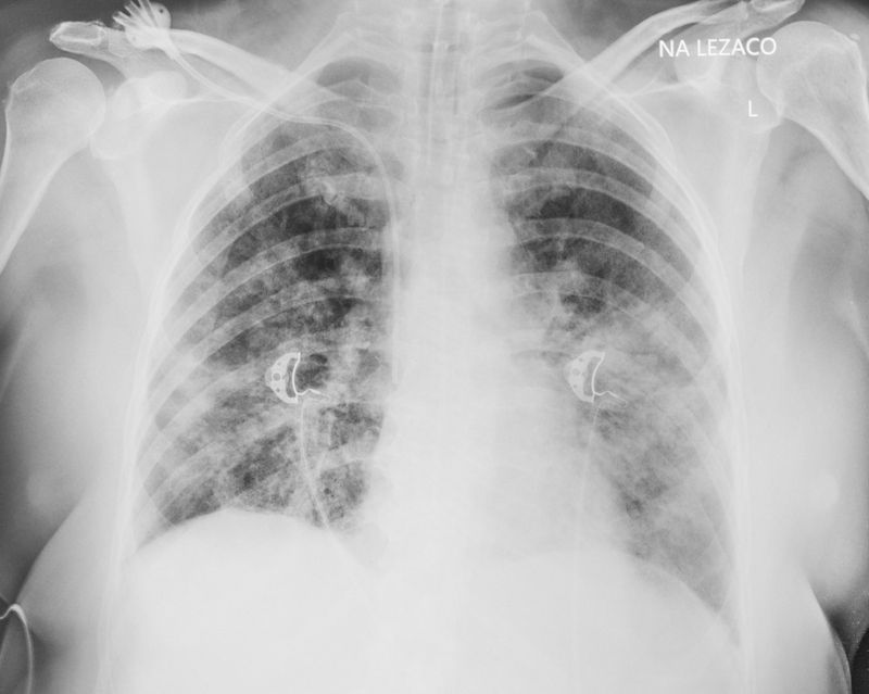 © Tomasz Lazar - X-ray of a person diagnosed with COVID-19. Warsaw, Poland, 01.05.2020
