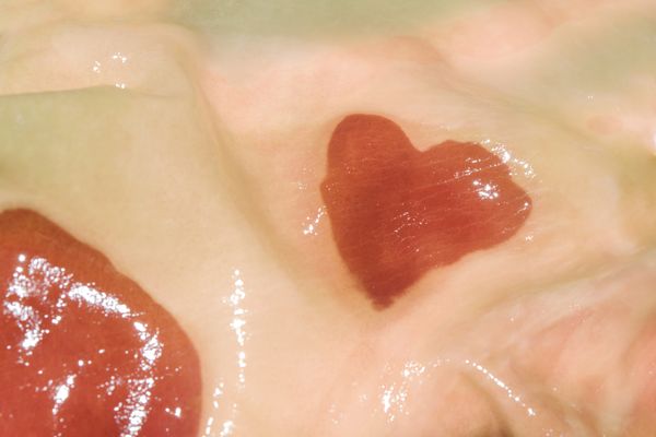 © Honey Long Prue Stent - Birth Mark