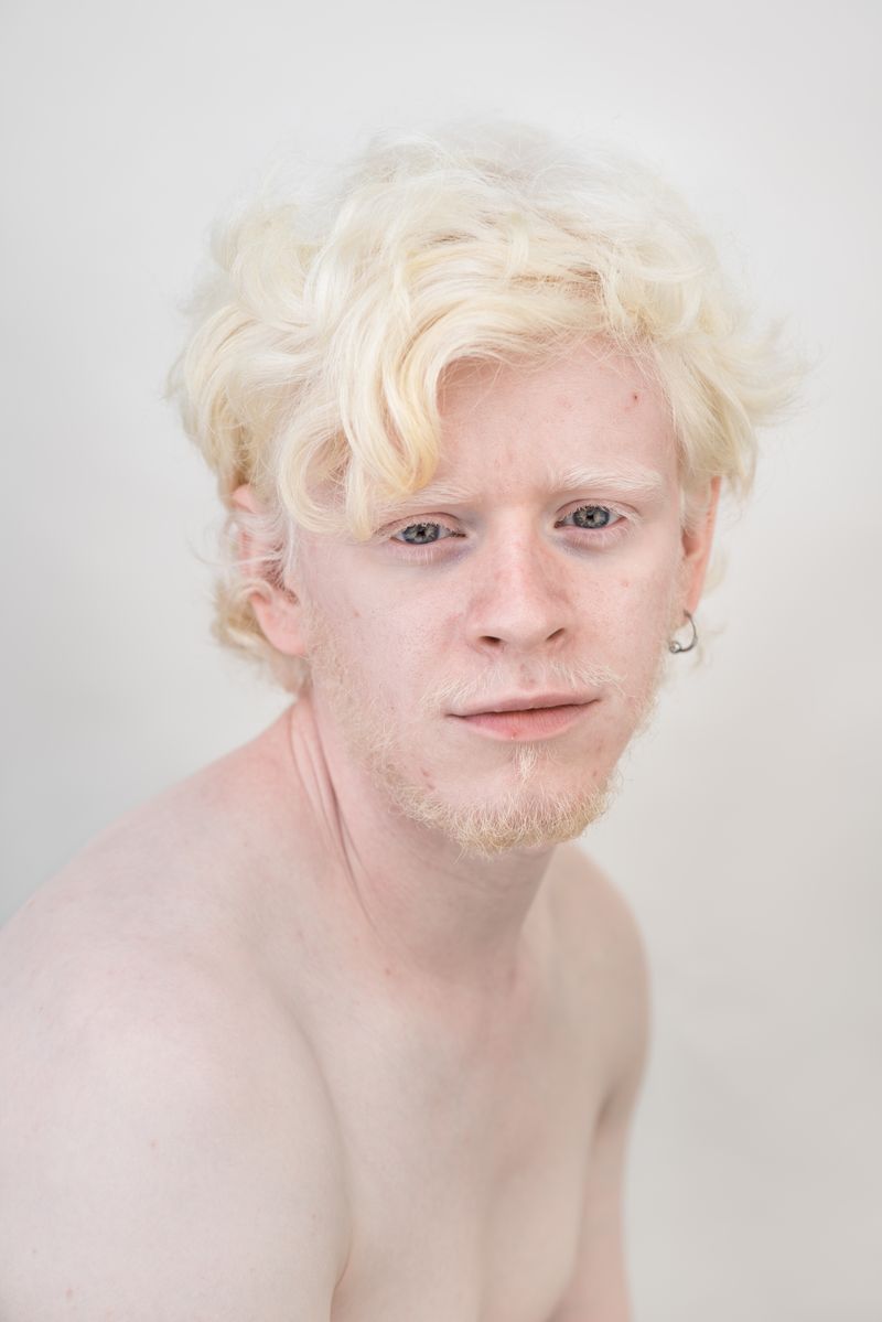 © Jorge Monaco - Image from the ALBINOS, BEING DIFFERENT photography project