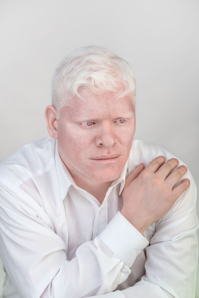 © Jorge Monaco - Image from the ALBINOS, BEING DIFFERENT photography project