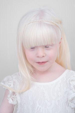 ALBINOS, BEING DIFFERENT