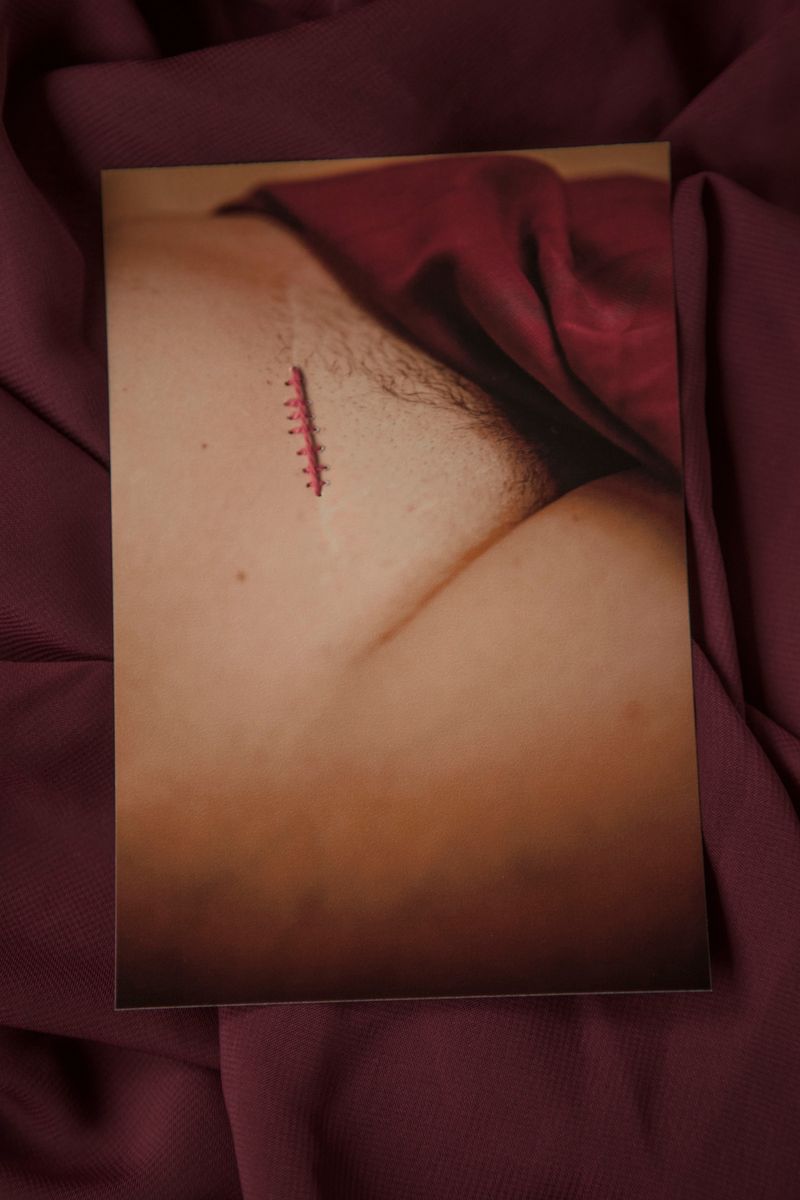 © Alina Gross - cesarean crack of pain, 2019