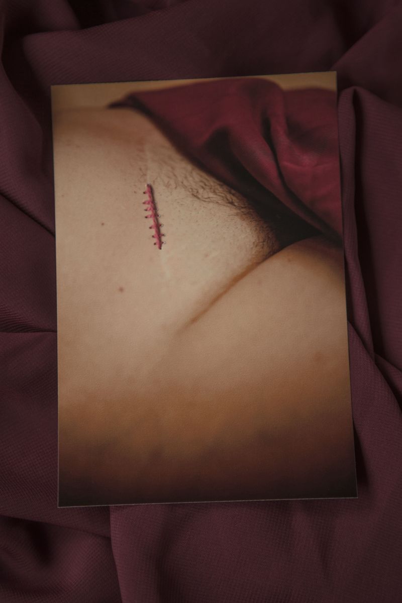 © Alina Gross - cesarean crack of pain, 2019
