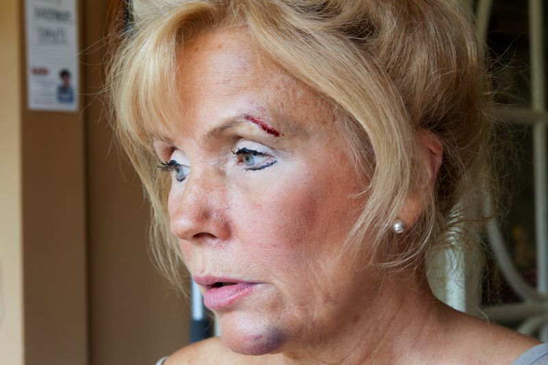 © Melissa Spitz - "I fell down and broke my jaw.", 2012