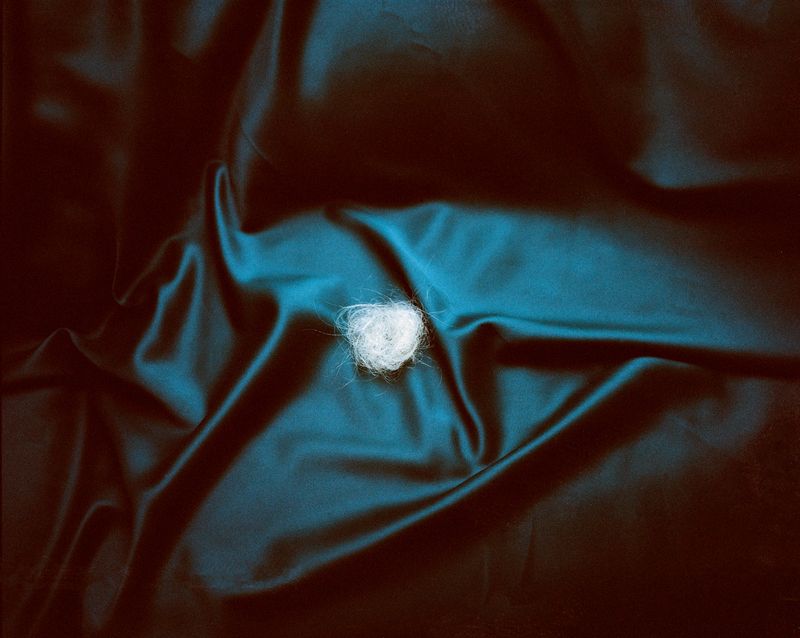 © Amelie Sachs - Common symptoms of PCOS include obesity, hair loss, excessive male hair growth, absent menstruation, and infertility.