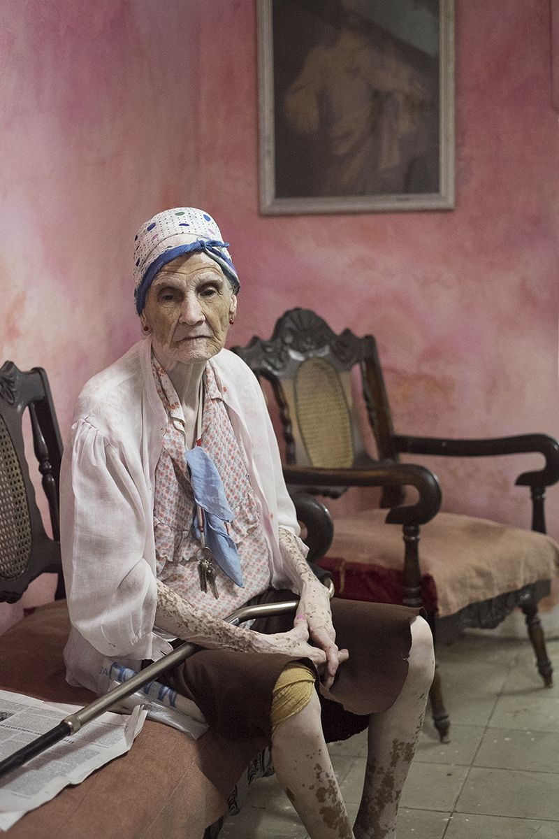 © Helga Salwe - Maria Hernandez suffers from a skin condition -Vitiligo. Which means she loses the pigmentation in her skin.