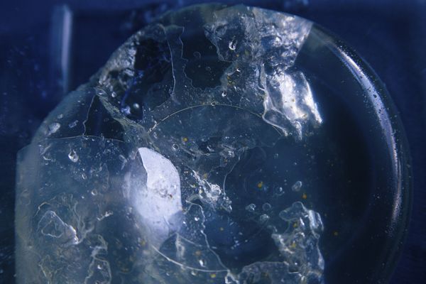 © Freisy González Portales - Broken implant (PIP) of Yurimara Amundaraín, replaced in 2007