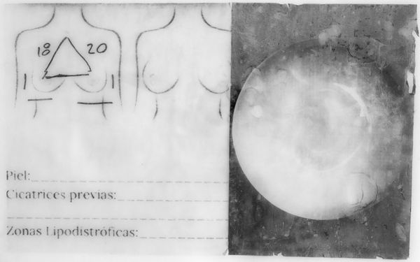 © Freisy González Portales - Projection and volume calculations for breast implants, by Surgeon Juan Carlos Blanco. Photo transfer on silicone.