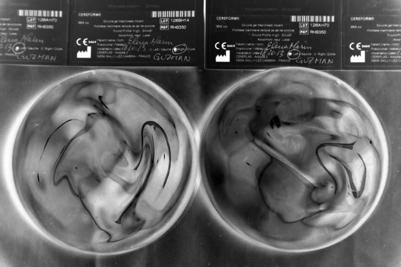 © Freisy González Portales - Breast implants and tags belonging to Elena Marín, 39, from Carupano. Implanted in 2013. Removed in 2023.