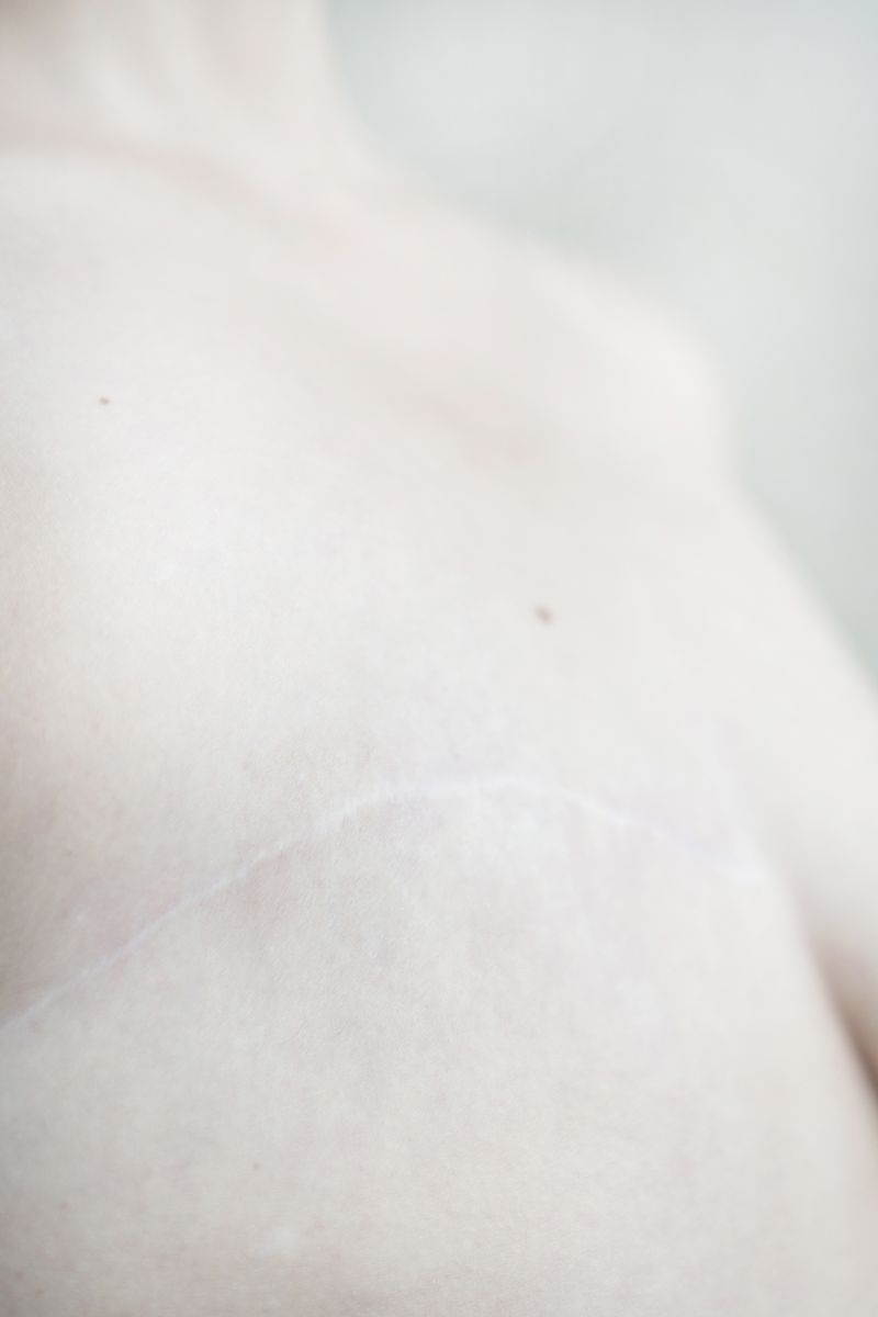 © Sergei Stroitelev - Scar left after mastectomy.
