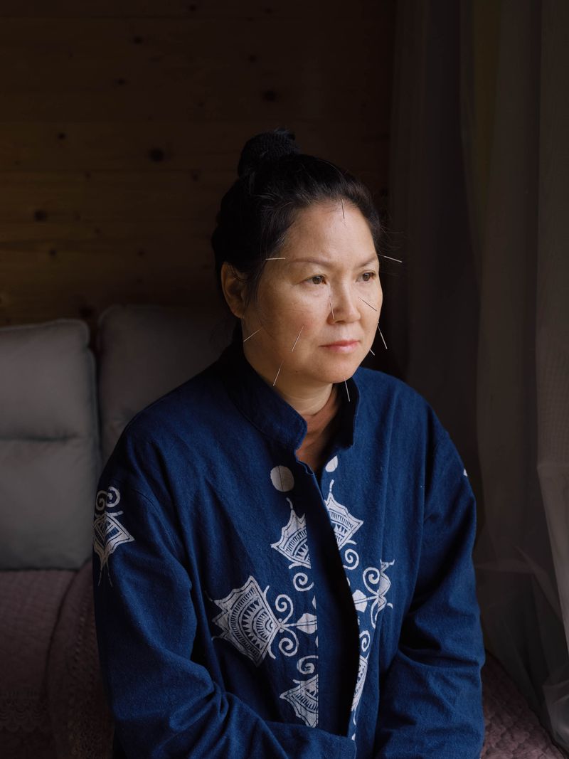 © Yixi Tian - Acupuncture for beauty