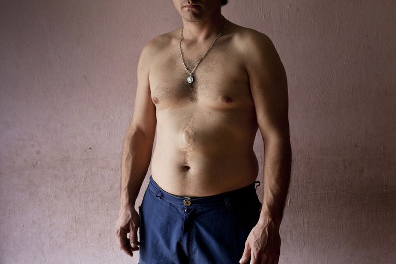 © Myriam Meloni - Some of the bullet scars caused by the 18 shots that Fernando received during the police raid.