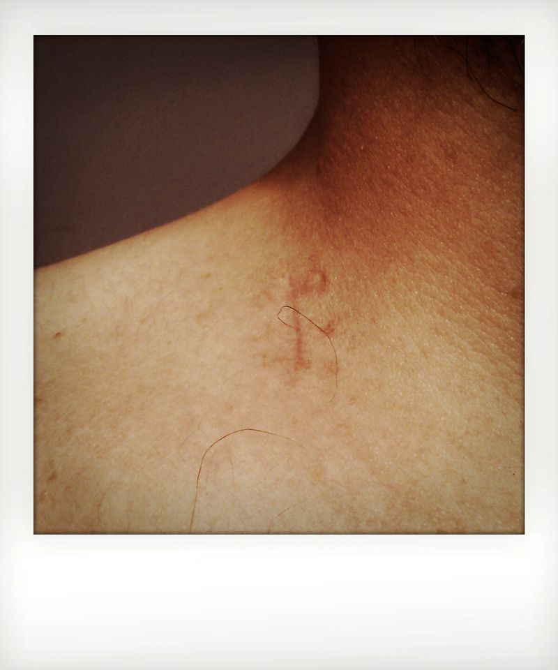 © Massimo Capocci - Histological examination scar. This mark represents the origin of my physical and emotional path linked to Mr. Hodgkin.