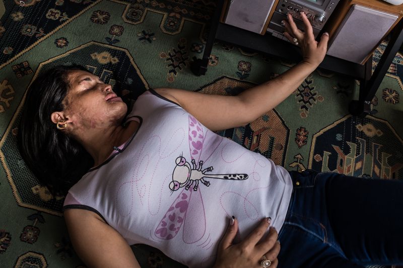 © Betty Laura Zapata - Image from the Facing Up: Acid Attacks in Colombia  photography project