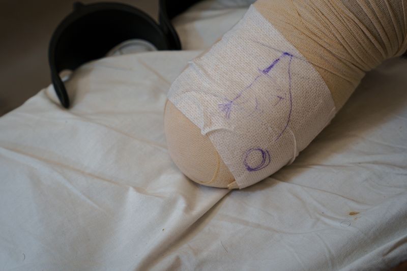 © Maxime Le Lijour - Image from the Gaza's amputees still wait for artificial limbs photography project