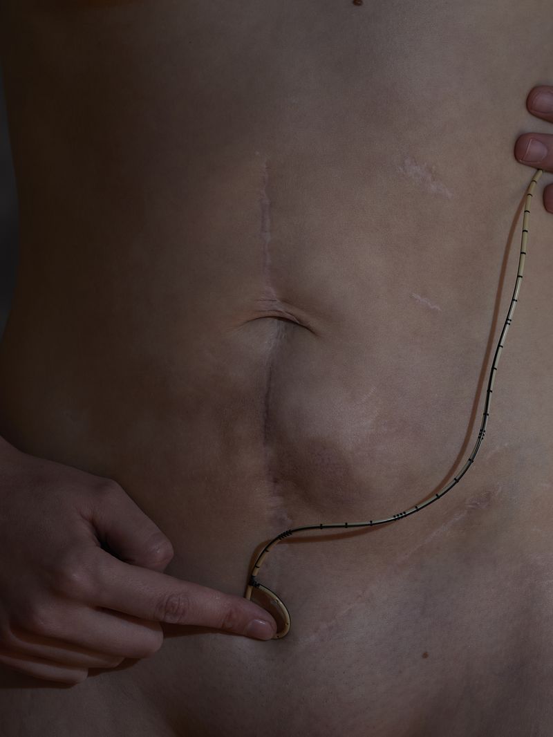 © andrealangphotography - Image from the Endosisters photography project