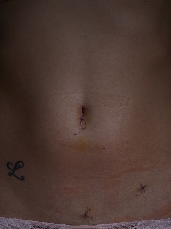 © andrealangphotography - Image from the Endosisters photography project
