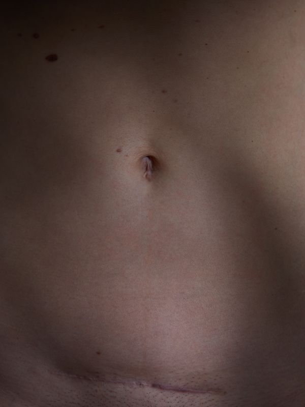 © andrealangphotography - Image from the Endosisters photography project