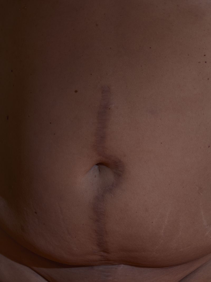 © andrealangphotography - Image from the Endosisters photography project